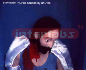 Homicidal injuries caused by an axe